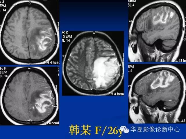 颅脑肿瘤MR诊断与鉴别诊断