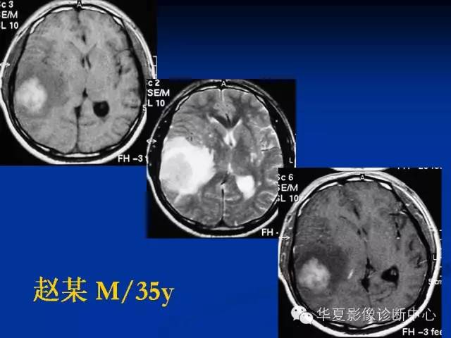 颅脑肿瘤MR诊断与鉴别诊断