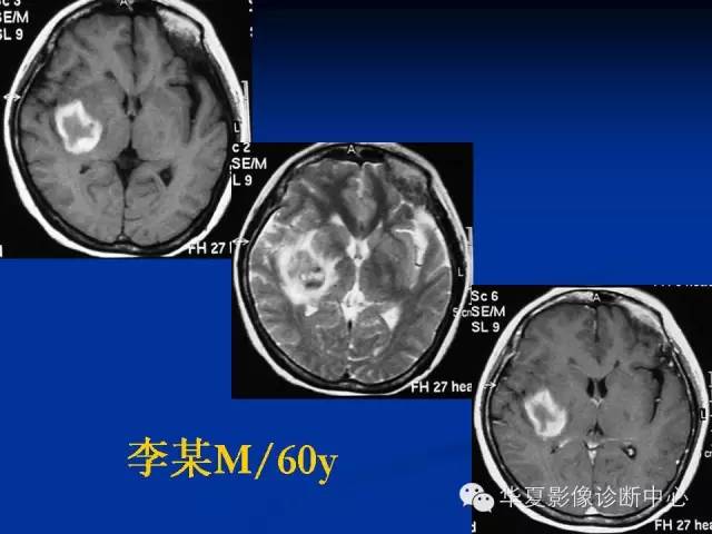 颅脑肿瘤MR诊断与鉴别诊断