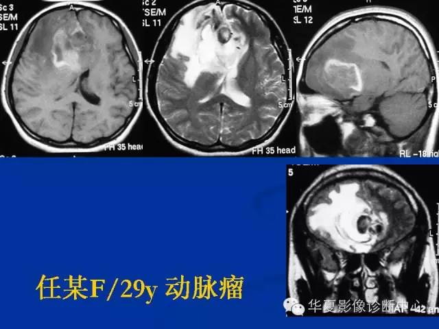 颅脑肿瘤MR诊断与鉴别诊断