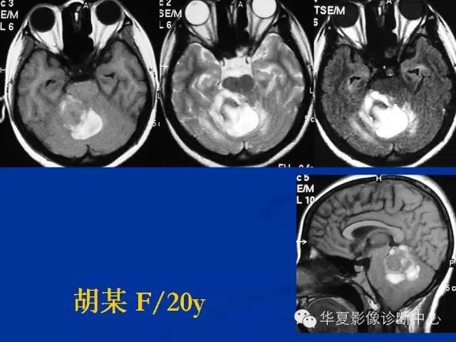 颅脑肿瘤MR诊断与鉴别诊断