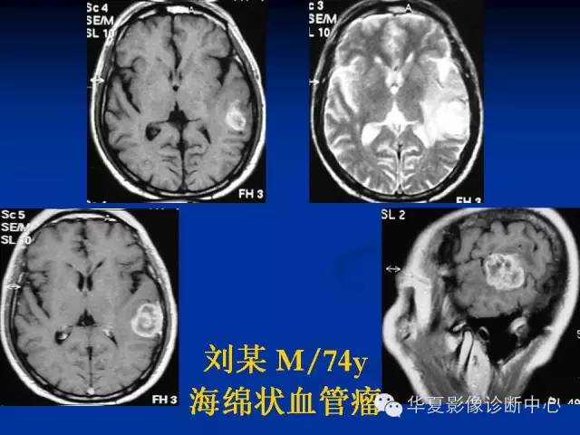 颅脑肿瘤MR诊断与鉴别诊断