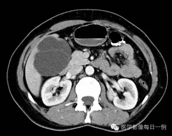 【病例】肝脏囊腺瘤1例CT影像表现 【病例】肝脏囊腺瘤1例CT影像表现