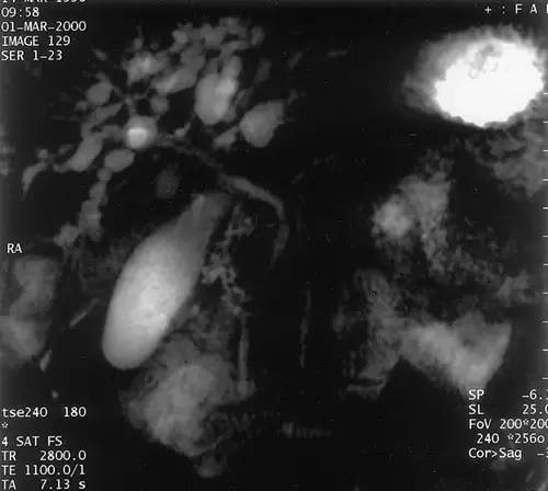 【病例】肝脏囊腺瘤1例CT影像表现 【病例】肝脏囊腺瘤1例CT影像表现