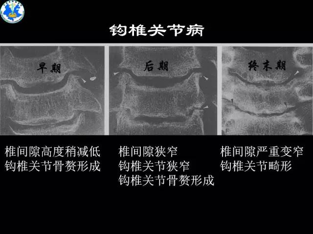 【PPT】脊柱退变性病变的分类及影像特征盘点