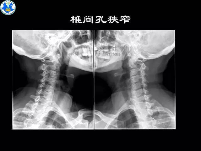 【PPT】脊柱退变性病变的分类及影像特征盘点