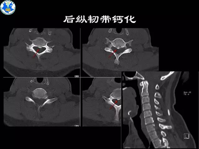 【PPT】脊柱退变性病变的分类及影像特征盘点