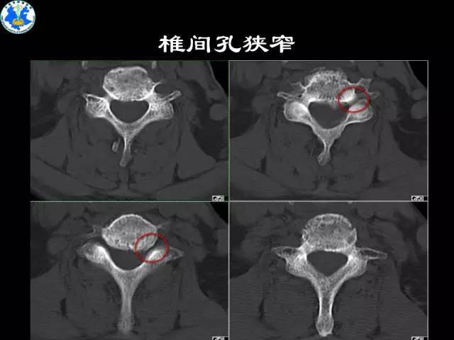 【PPT】脊柱退变性病变的分类及影像特征盘点