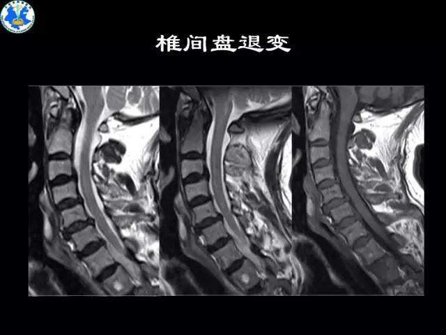 【PPT】脊柱退变性病变的分类及影像特征盘点