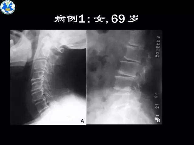 【PPT】脊柱退变性病变的分类及影像特征盘点