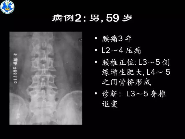 【PPT】脊柱退变性病变的分类及影像特征盘点