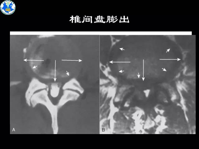 【PPT】脊柱退变性病变的分类及影像特征盘点