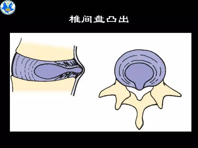 【PPT】脊柱退变性病变的分类及影像特征盘点