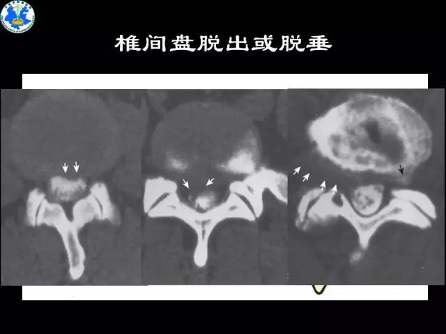 【PPT】脊柱退变性病变的分类及影像特征盘点