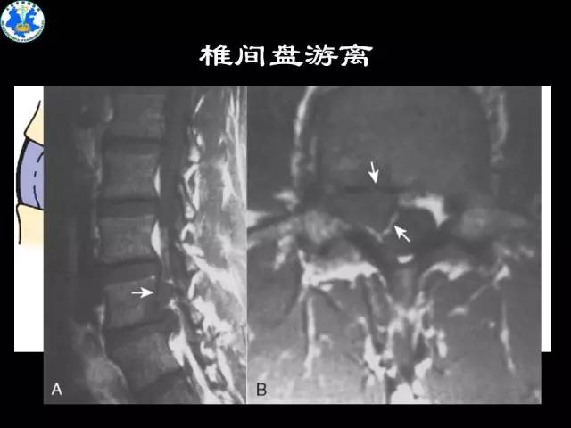 【PPT】脊柱退变性病变的分类及影像特征盘点