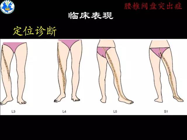 【PPT】脊柱退变性病变的分类及影像特征盘点