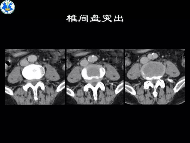 【PPT】脊柱退变性病变的分类及影像特征盘点