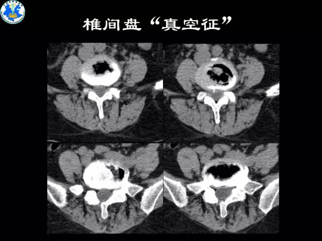 【PPT】脊柱退变性病变的分类及影像特征盘点