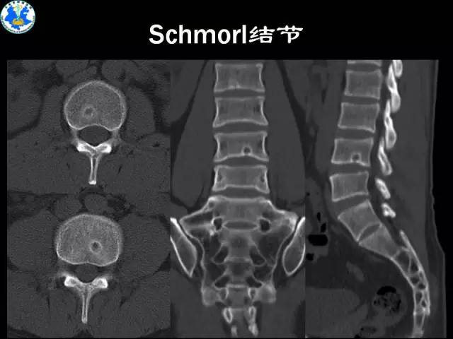 【PPT】脊柱退变性病变的分类及影像特征盘点