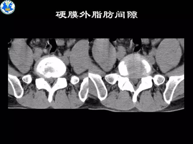 【PPT】脊柱退变性病变的分类及影像特征盘点