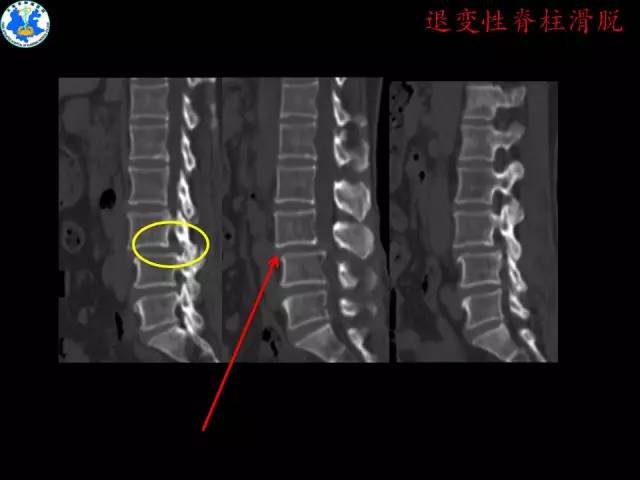 【PPT】脊柱退变性病变的分类及影像特征盘点