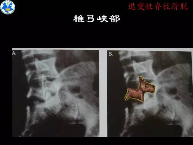 【PPT】脊柱退变性病变的分类及影像特征盘点