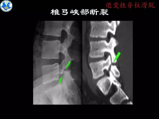【PPT】脊柱退变性病变的分类及影像特征盘点