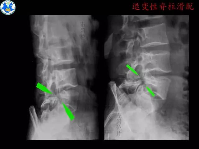 【PPT】脊柱退变性病变的分类及影像特征盘点