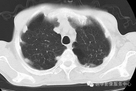 【病例】类风湿肺部浸润1例CT影像表现 【病例】类风湿肺部浸润1例CT影像表现