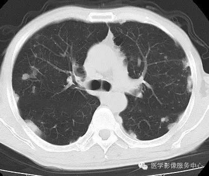 【病例】类风湿肺部浸润1例CT影像表现 【病例】类风湿肺部浸润1例CT影像表现