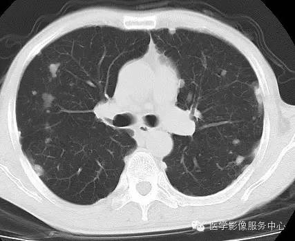 【病例】类风湿肺部浸润1例CT影像表现 【病例】类风湿肺部浸润1例CT影像表现