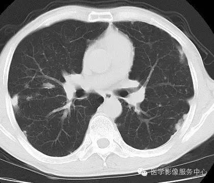 【病例】类风湿肺部浸润1例CT影像表现 【病例】类风湿肺部浸润1例CT影像表现