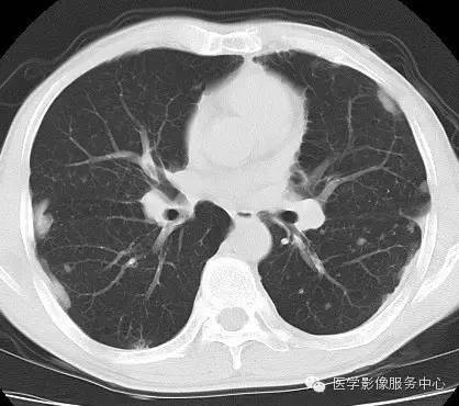 【病例】类风湿肺部浸润1例CT影像表现 【病例】类风湿肺部浸润1例CT影像表现