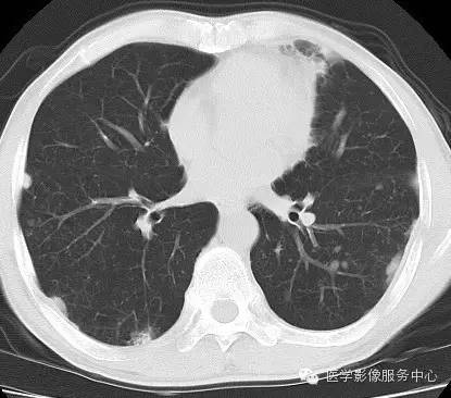 【病例】类风湿肺部浸润1例CT影像表现 【病例】类风湿肺部浸润1例CT影像表现