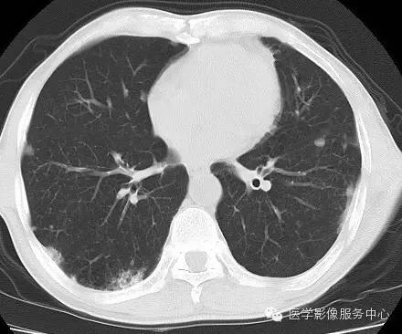 【病例】类风湿肺部浸润1例CT影像表现 【病例】类风湿肺部浸润1例CT影像表现