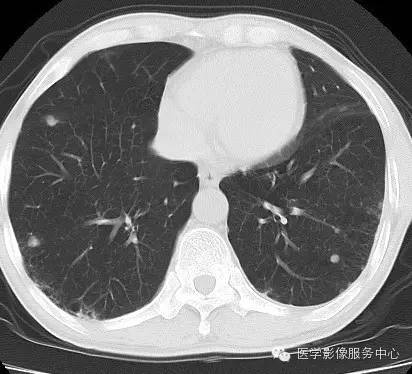 【病例】类风湿肺部浸润1例CT影像表现 【病例】类风湿肺部浸润1例CT影像表现