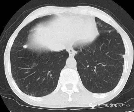 【病例】类风湿肺部浸润1例CT影像表现 【病例】类风湿肺部浸润1例CT影像表现