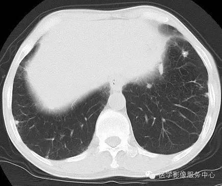 【病例】类风湿肺部浸润1例CT影像表现 【病例】类风湿肺部浸润1例CT影像表现