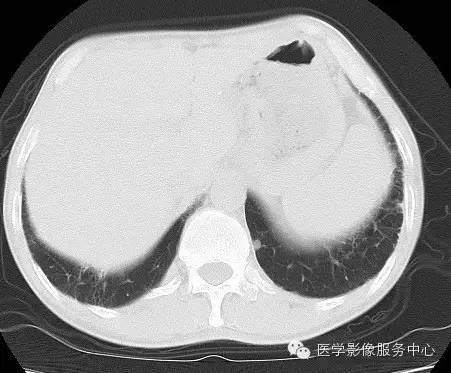 【病例】类风湿肺部浸润1例CT影像表现 【病例】类风湿肺部浸润1例CT影像表现