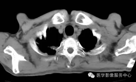 【病例】类风湿肺部浸润1例CT影像表现 【病例】类风湿肺部浸润1例CT影像表现