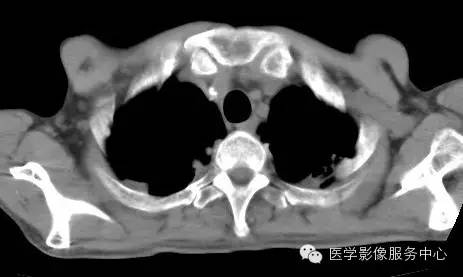 【病例】类风湿肺部浸润1例CT影像表现 【病例】类风湿肺部浸润1例CT影像表现