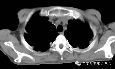 【病例】类风湿肺部浸润1例CT影像表现 【病例】类风湿肺部浸润1例CT影像表现