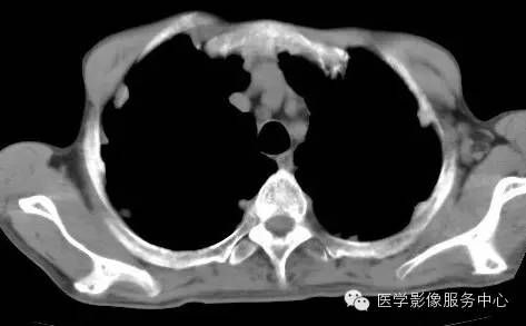 【病例】类风湿肺部浸润1例CT影像表现 【病例】类风湿肺部浸润1例CT影像表现