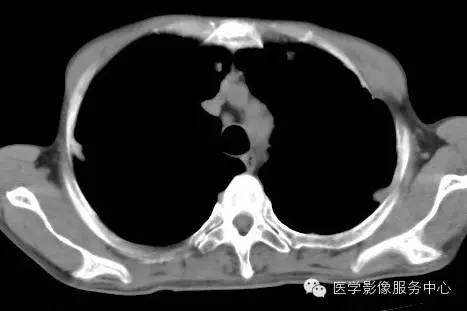 【病例】类风湿肺部浸润1例CT影像表现 【病例】类风湿肺部浸润1例CT影像表现