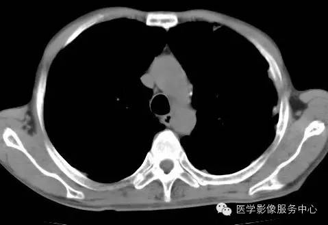 【病例】类风湿肺部浸润1例CT影像表现 【病例】类风湿肺部浸润1例CT影像表现