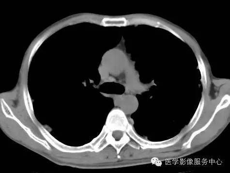 【病例】类风湿肺部浸润1例CT影像表现 【病例】类风湿肺部浸润1例CT影像表现