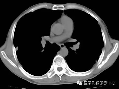 【病例】类风湿肺部浸润1例CT影像表现 【病例】类风湿肺部浸润1例CT影像表现