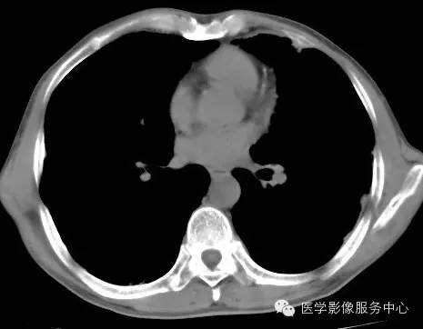 【病例】类风湿肺部浸润1例CT影像表现 【病例】类风湿肺部浸润1例CT影像表现