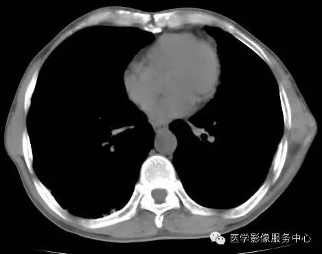 【病例】类风湿肺部浸润1例CT影像表现 【病例】类风湿肺部浸润1例CT影像表现