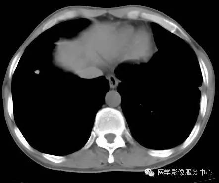 【病例】类风湿肺部浸润1例CT影像表现 【病例】类风湿肺部浸润1例CT影像表现